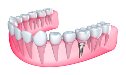 Missing Tooth Replacement 